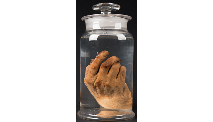 Preserved right hand of Dr. Daniel S. Lamb