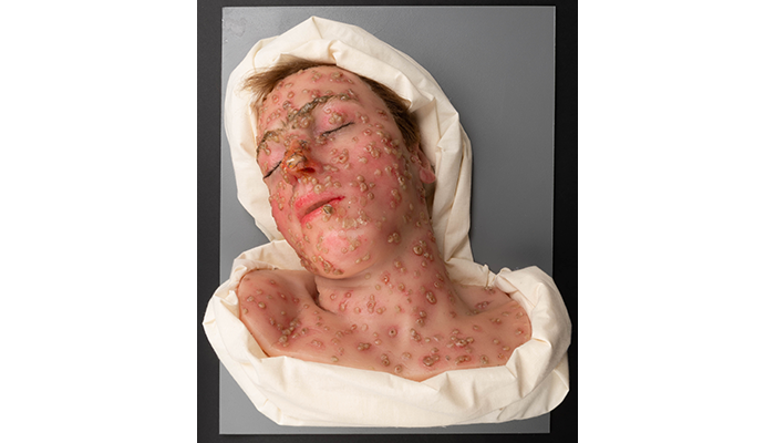 wax moulage depicting smallpox