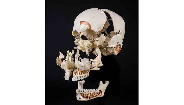 A skull prepared in the Beauchêne method