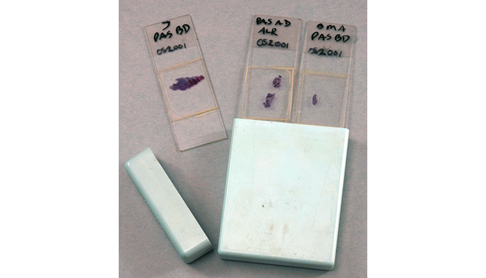 Histology slides from a 1980 recut of President Cleveland's 1893 palatal tumor