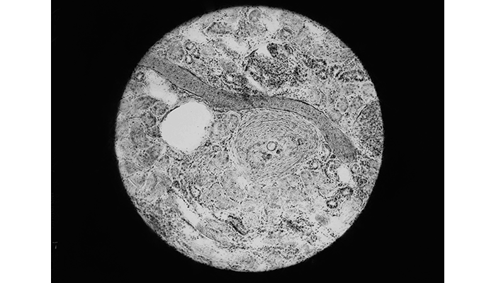 Microscope slide; fat embolism in the kidney