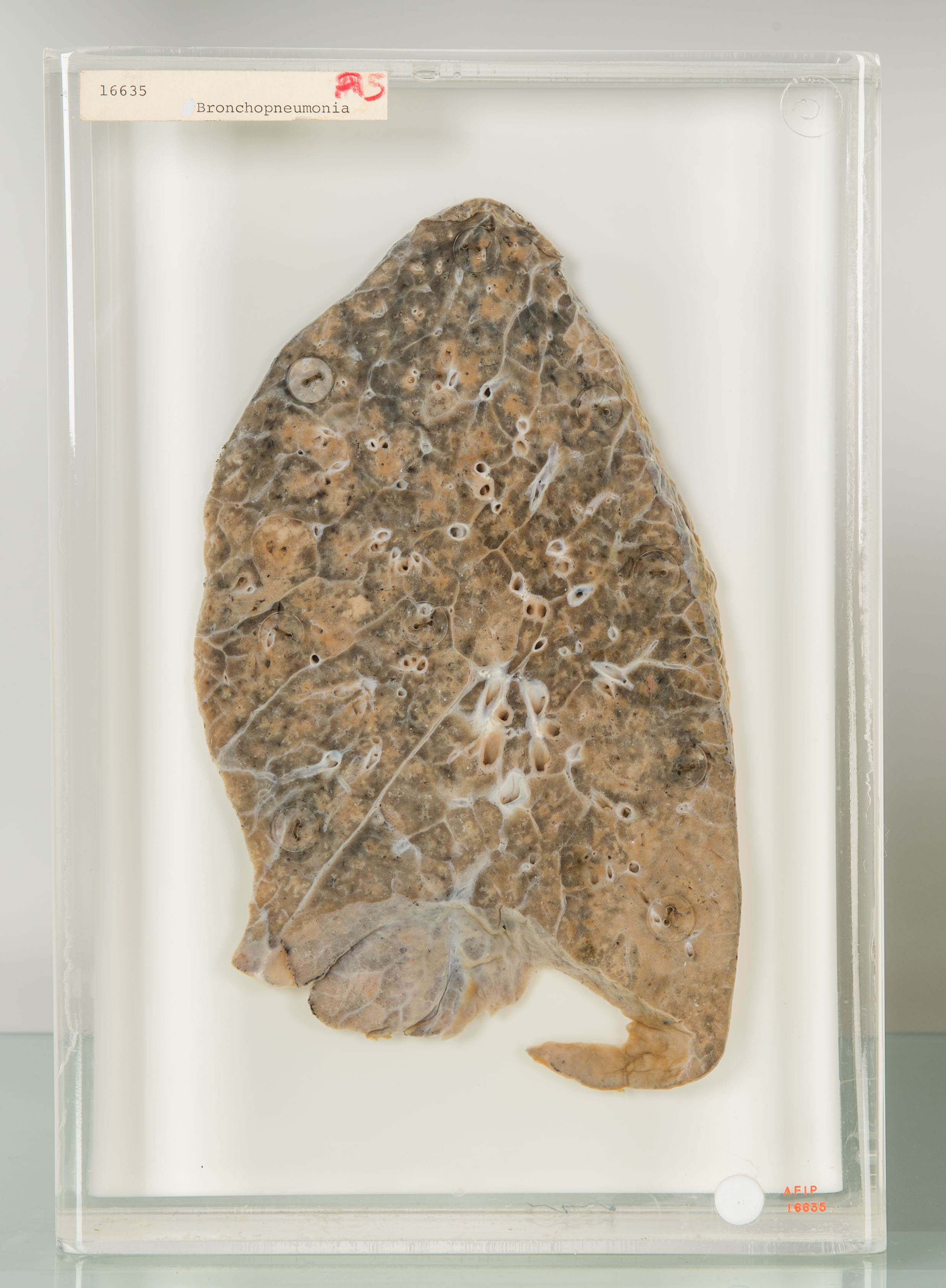 Section of lung infected with bronchopneumonia from 1918 influenza preserved in fluid-filled glass jar.