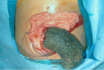 Surgical extraction of trichobezoar