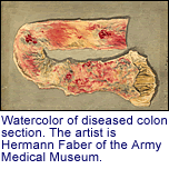 Watercolor of diseased colon section.
      The artist is Hermann Faber of the Army Medical Museum.