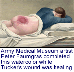Army Medical Museum artist Peter
    Baumgras completed this watercolor while Tucker's wound was healing