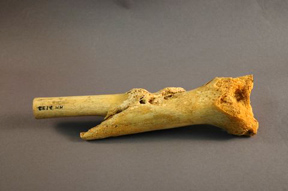 Lower thigh bone of Private Oscar Cunningham
National Museum of Health and Medicine 1000755