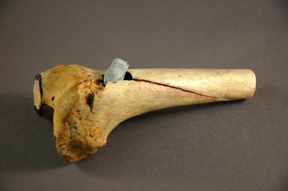 Lower thigh bone of Corporal Frank Irwin.
National Museum of Health and Medicine 1002803 