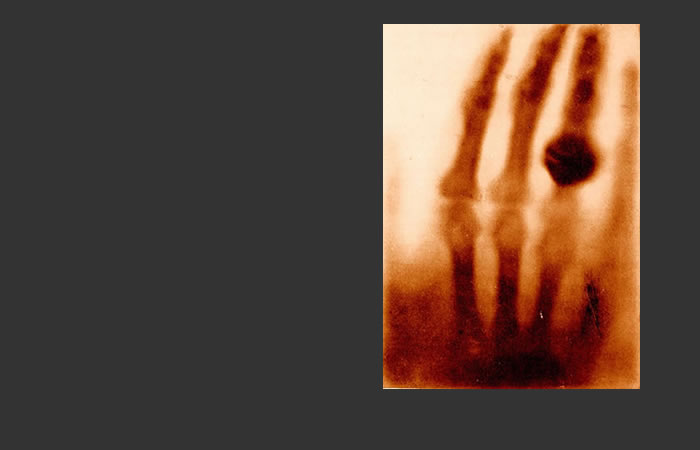 Sepia-toned image of the X-ray Röntgen's wife's hand showing finger bones and her ring.